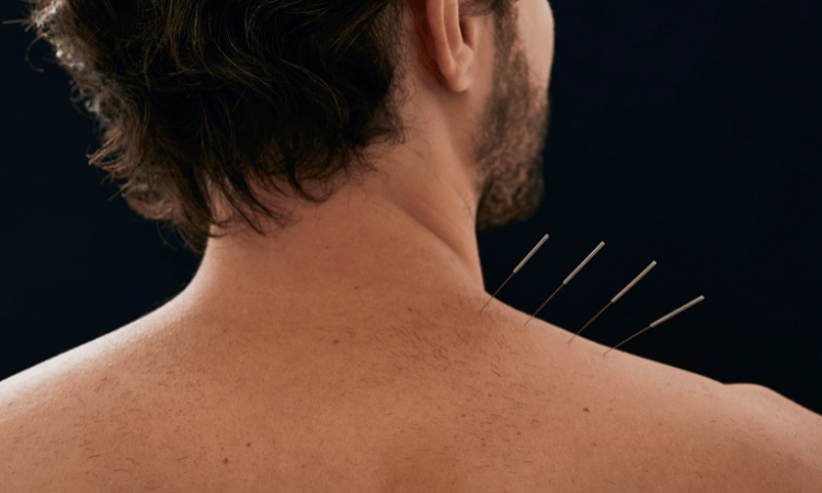Puntos Shu en acupuntura: qué son y cómo utilizarlos